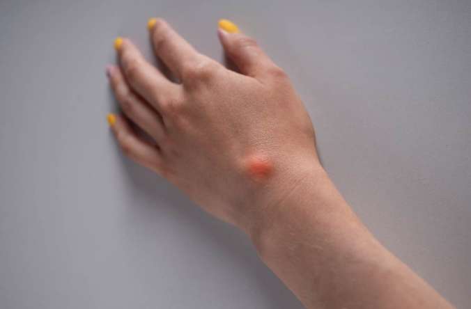 脂肪瘤手術風險