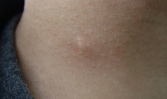 脂肪瘤治療 脂肪瘤治療