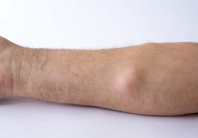 脂肪瘤治療 脂肪瘤治療