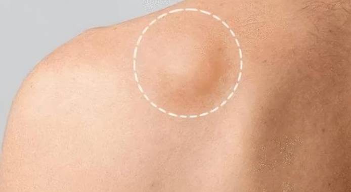 脂肪瘤切除後照顧