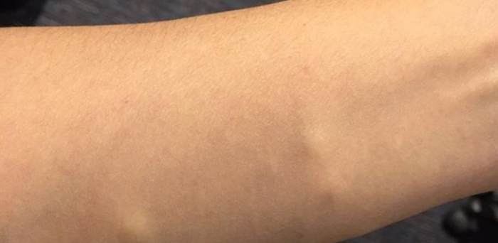 脂肪瘤自然消退 脂肪瘤自然消退