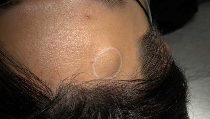 脂肪瘤切除後照顧