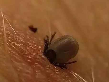 蜱蟲叮咬症狀