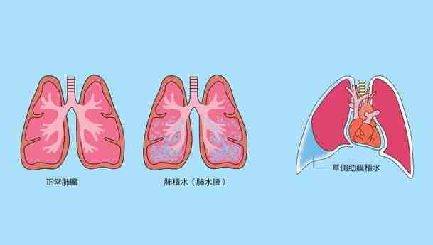 狗狗肺水腫 狗狗肺水腫
