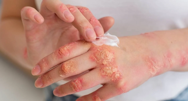 金錢癬治療方法