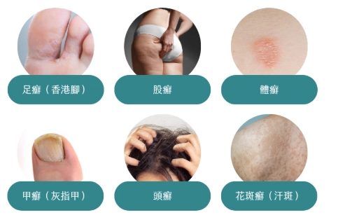 金錢癬治療方法