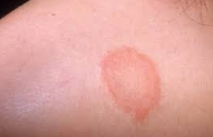 金錢癬多久會好