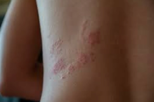 金錢癬多久會好