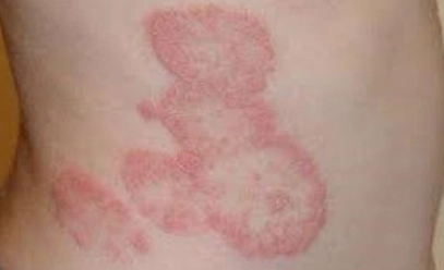 皮膚癬藥膏比較