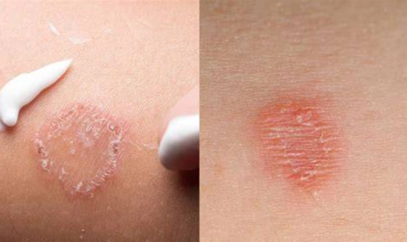 金錢癬治療藥膏