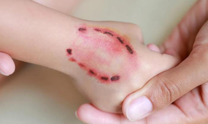 狗咬傷狂犬病預防 狗咬傷狂犬病預防