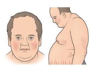 庫欣氏症症狀 庫欣氏症症狀