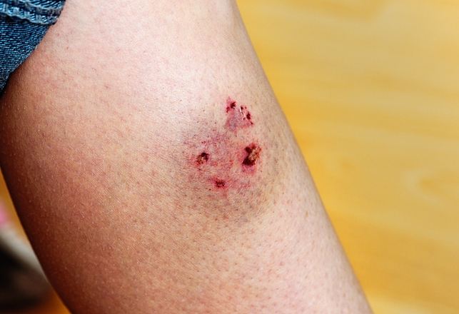 狂犬病疫苗必要性 狂犬病疫苗必要性