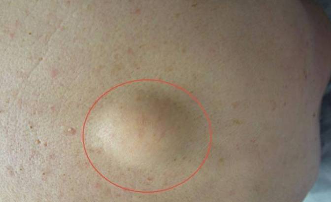 脂肪瘤手術後遺症