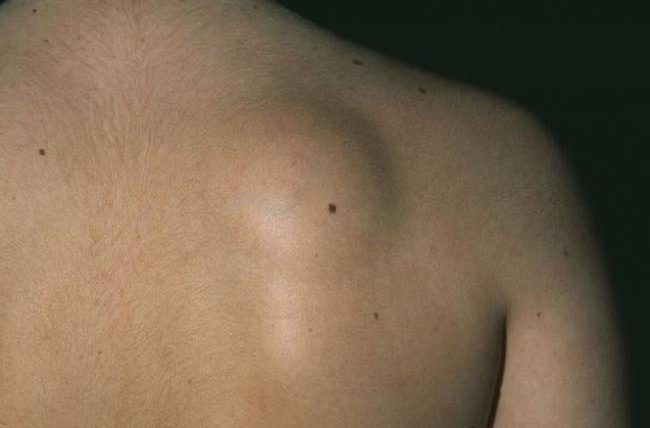 脂肪瘤會消失嗎