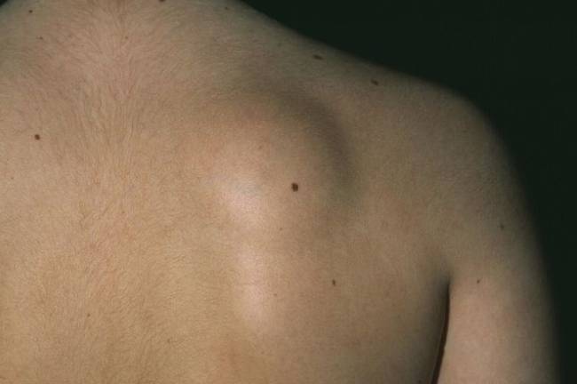 脂肪瘤會消失嗎？專家解析自然消退可能性與治療選擇