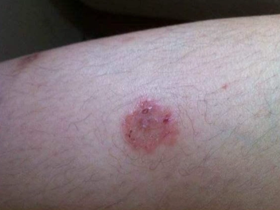 金錢癬初期圖片