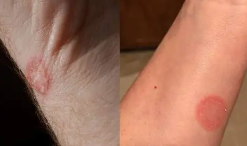 金錢癬初期症狀