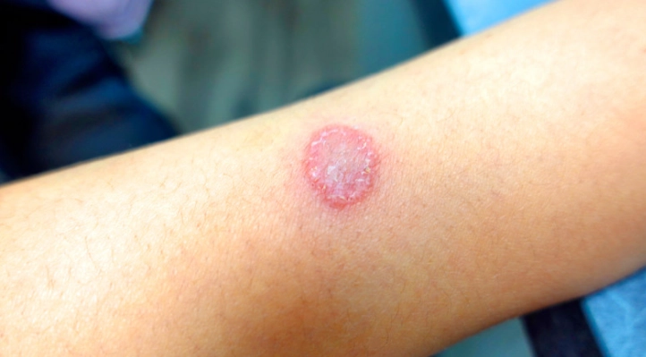 金錢癬初期症狀