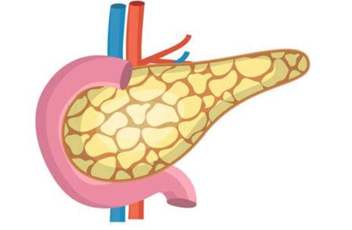 急性胰臟炎治療