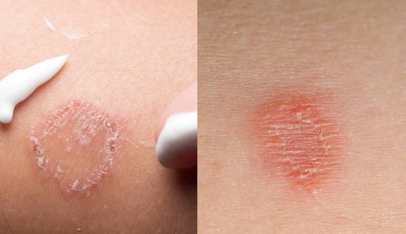 金錢癬初期治療