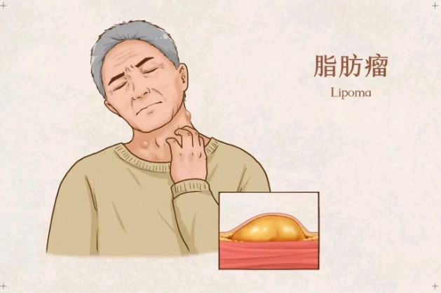 脂肪瘤原因 脂肪瘤原因