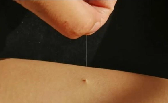 針灸治療脂肪瘤 針灸治療脂肪瘤