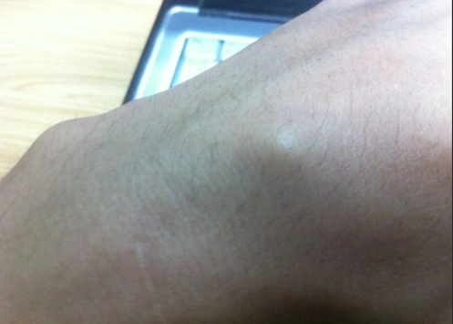 脂肪瘤 自然消失