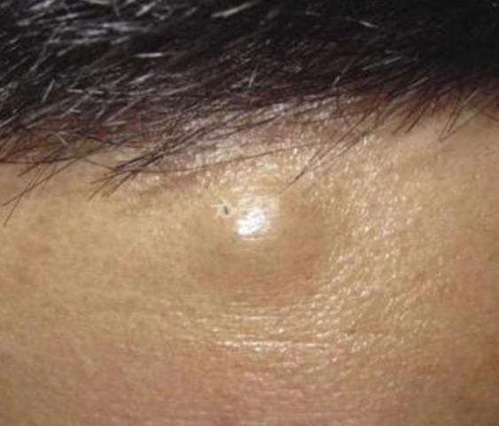 脂肪瘤 不處理 會怎樣