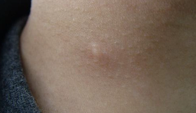 脂肪瘤 不處理 會怎樣