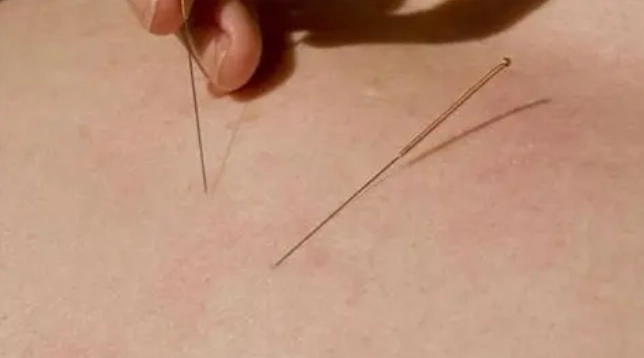 針灸治療脂肪瘤 針灸治療脂肪瘤