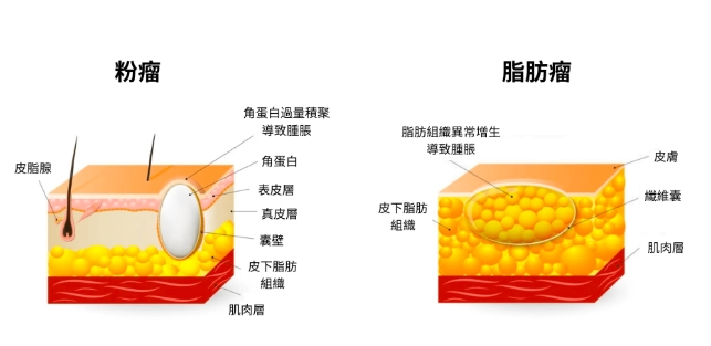 脂肪瘤是什麼 脂肪瘤是什麼