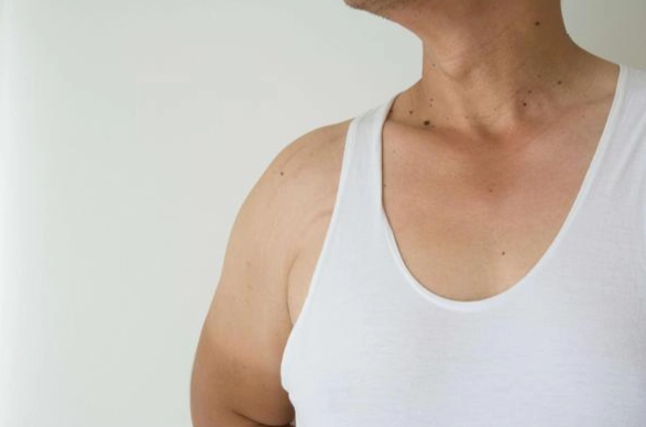 脂肪瘤 自然消失