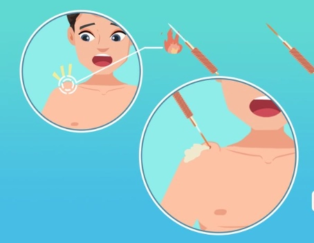 脂肪瘤會自己消失嗎 脂肪瘤會自己消失嗎