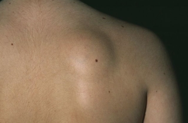 脂肪瘤 自然消失