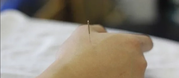 脂肪瘤針灸 脂肪瘤針灸