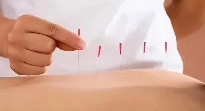 脂肪瘤針灸 脂肪瘤針灸