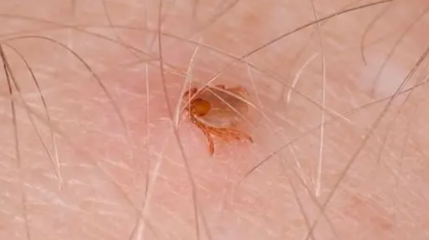 壁蝨咬傷處理 壁蝨咬傷處理