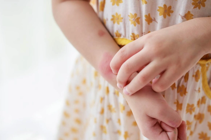 壁蝨叮咬預防 壁蝨叮咬預防