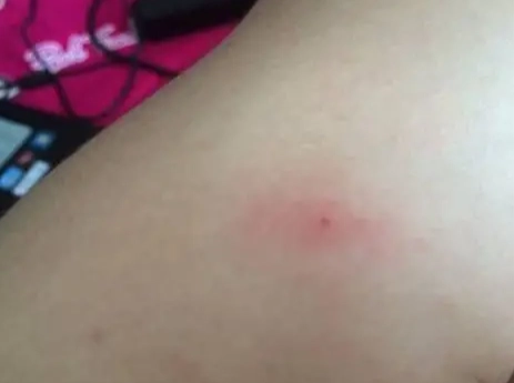 壁蝨咬傷處理 壁蝨咬傷處理