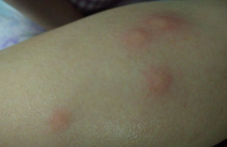 人被壁蝨咬症狀 人被壁蝨咬症狀