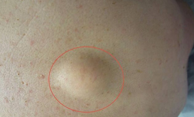 脂肪瘤可以按摩嗎