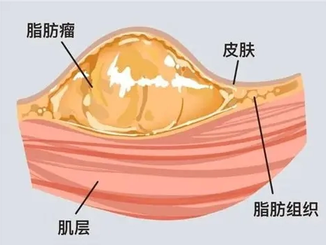 脂肪瘤按摩