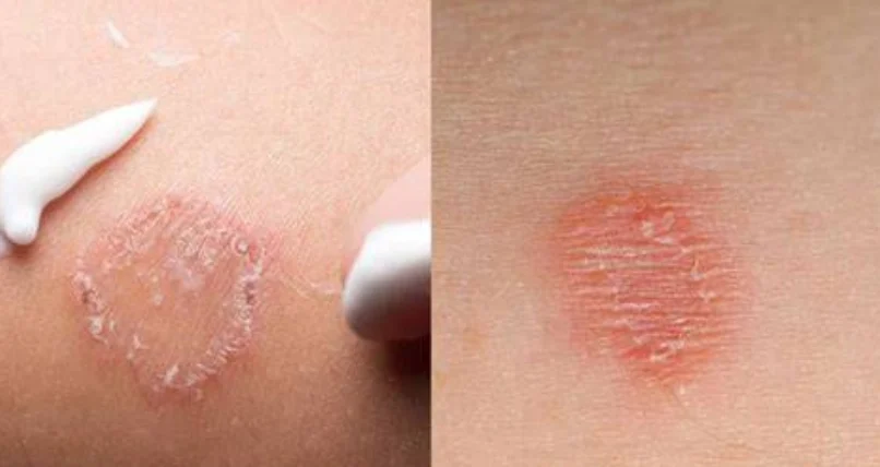 金錢癬藥膏推薦